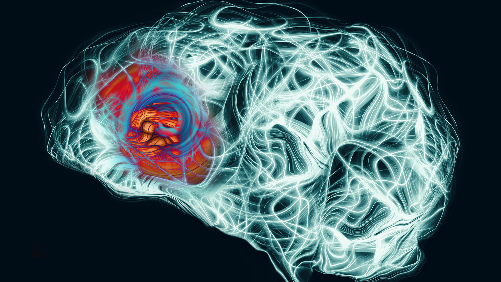 Informan el primer caso mundial de alzheimer en un paciente…