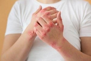 Sífilis en alza en Misiones: advierten por la tendencia ‘a pelo’ entre jóvenes y la falta de preservativos del Estado nacional